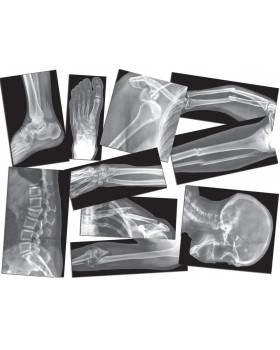 Rentgenové snímky zlomených kostí